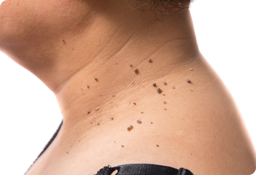 The Woodlands Skin Tag Removal | Veda Health | Direct Primary Care | The Woodlands | Texas